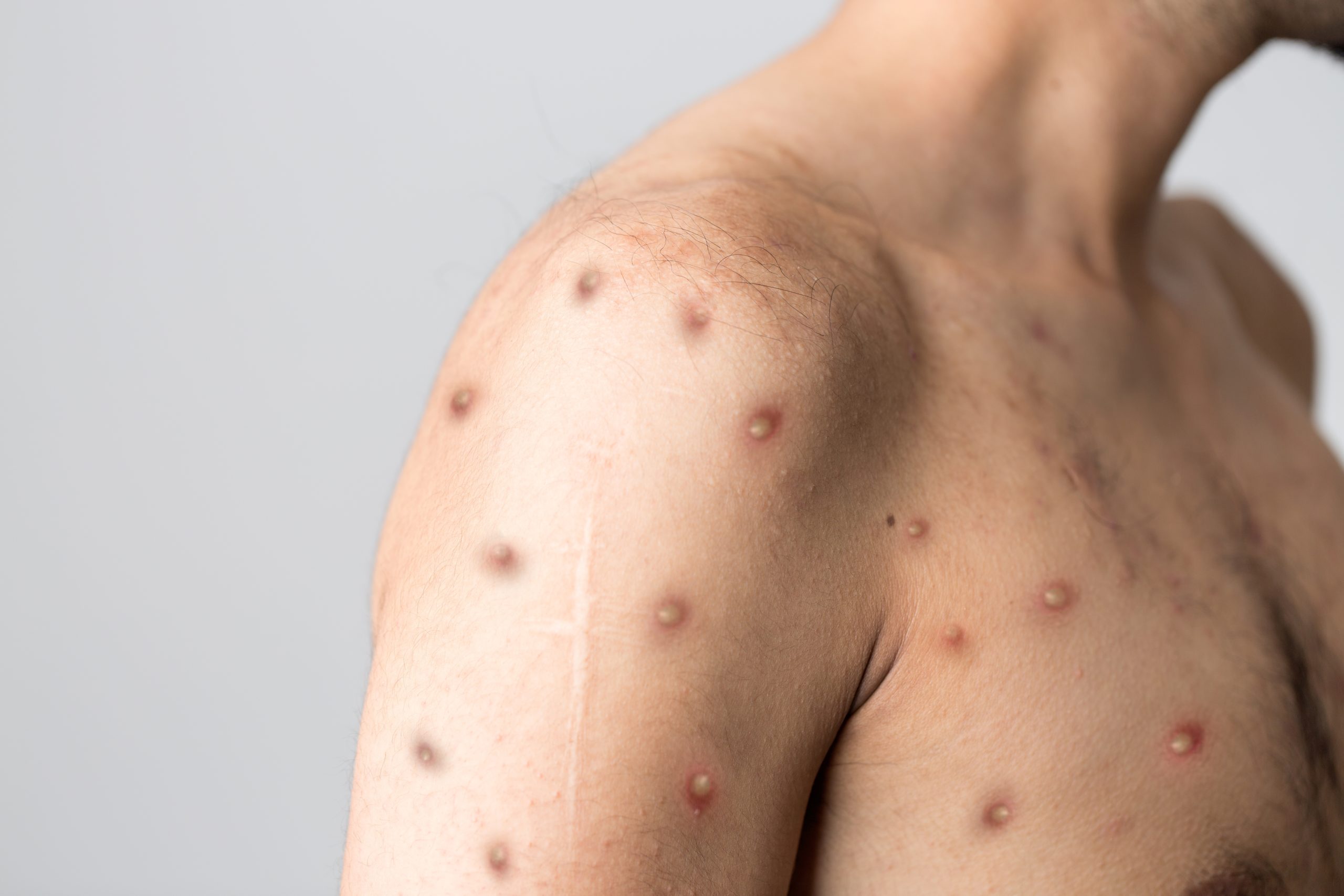 What You Should Know About Monkeypox, Lexington Medical Center Blog